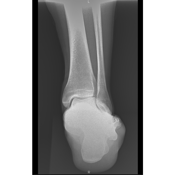 Value of modified axial review radiograph in diagnosing calcaneal fractures  | Scientific Reports